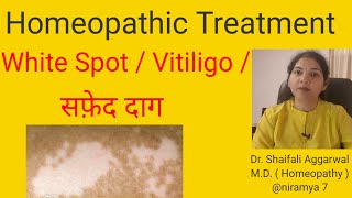 White spot Vitiligo सफ़ेद दाग Homeopathic Treatment for White spot  Vitiligo सफ़ेद दाग [upl. by Pablo]