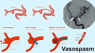 vasospasm [upl. by Garcon]