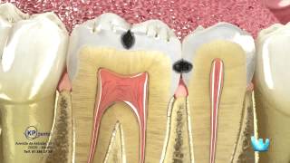 Odontología para Pacientes  La caries y la restauración [upl. by Heimer]