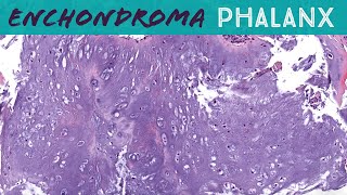 Enchondroma special rules for cartilage tumors in phalanx fingers toes hands feet bone pathology [upl. by Neelhtac162]