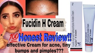 Fucidin H Cream 100 Honest Review amp Uses  Say no to Tiny Bumps  Acne and Pimples  Myra Sharma [upl. by Mortimer]