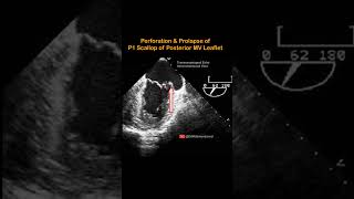 Prolapse of P1 scallop of Posterior Mitral Valve Leaflet echocardiography cardiology doctor [upl. by Aicenert]