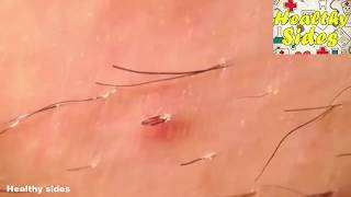 Ingrown Hair  Infected Ingrown Hair  Ingrown Hair Removal Video [upl. by Donetta]