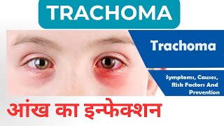 Trachoma रोहे आंख का इन्फेक्शन । कैसे फैलता है और क्यों [upl. by Hardner618]