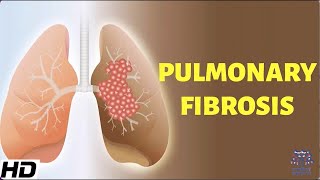 Pulmonary Fibrosis Everything You Need To Know [upl. by Zetrom646]