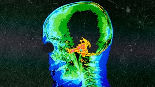 A Boy Ate 180 Gummy Melatonins For Lunch This Is What Happened To His Brain [upl. by Gisele]