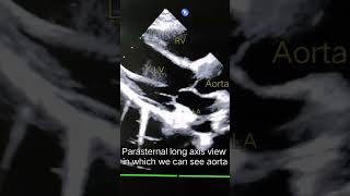 Parasternal long axis view basic in 2D echocardiography [upl. by Nolham]