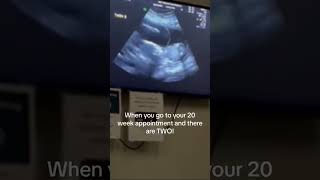 Ultrasound scan In Pregnancy [upl. by Siuqram581]