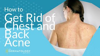 HOW I CURED MY BACK ACNE BeforeAfter Photos  Euodias [upl. by O'Gowan873]