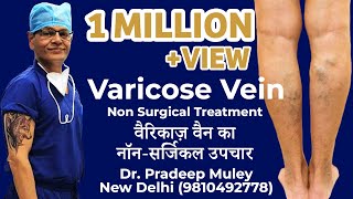 Varicose vein treatment procedure MicrowaveRFALaser Ablation Surgery [upl. by Neleh960]