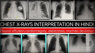 Chest x ray padhna sikhepleural effusion cardiomegaly atelectasis trachea deviation [upl. by Danuloff]