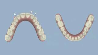 Invisalign  Midline Shift and IPR  Dr Thomas Gibbs DDS [upl. by Beetner719]