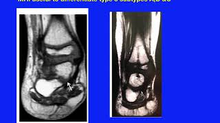 Fibular hemimelia 6 cases managed according tp Dr Paley reconstructive method [upl. by Sargent]