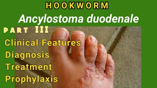 Hookworm  Ancylostomiasis Clinical Features Diagnosis Treatment Prophylaxis  AM Biologie Notes [upl. by Oirevas]