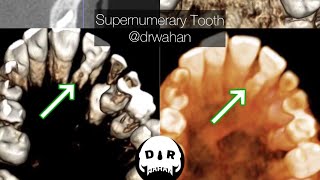 Supernumerary Tooth Removal from Palate Step by Step [upl. by Weiss]