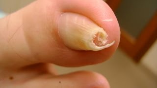 Home Remedies for Toenail Fungus That Work [upl. by Eniluj]