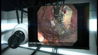 Gastric Cancer [upl. by Aneres642]