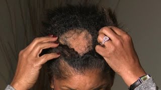 What Is Causing This Woman’s Extreme Hair Loss [upl. by Culhert]