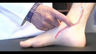 How to diagnose Posterior Tibial Tendonitis [upl. by Hcra]