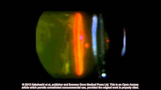 Classification of posterior vitreous detachment ID 54021 Supplementary video 7 [upl. by Acinehs856]