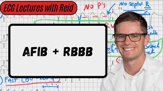 Atrial Fibrillation w Right Bundle Branch Block  Day 15 ECG Challenge [upl. by Zela721]
