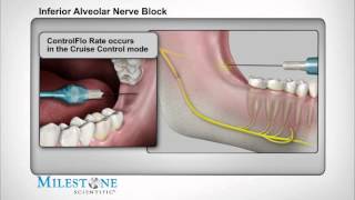 Inferior Alveolar Nerve Block [upl. by Padriac]