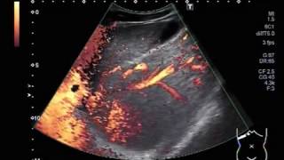 Ultrasound Video showing Hepatic parenchymal disease in a young patient of about 23 years [upl. by Alonzo]