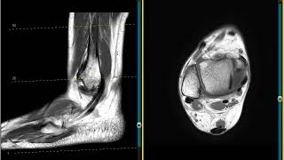 Accessory peroneus quartus muscle ankle [upl. by Aytnahs]