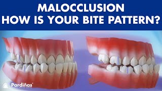 Malocclusion  Bite patterns © [upl. by Roselba]