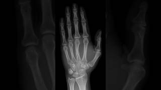 Third metacarpal fracture xrayhand [upl. by Annoirb]