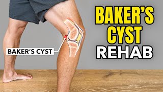 Bakers Cyst Treatment Rehab Exercises [upl. by Nekal510]