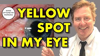 YELLOW SPOT IN EYE Pinguecula treatment from Youtube Eye Doctor amp Optometrist [upl. by Zsa Zsa151]