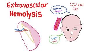 Extravascular Hemolysis [upl. by Il605]