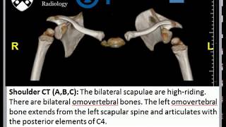 Sprengel Deformity [upl. by Durning]