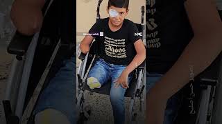 Palestinian child loses eye leg and arm in Israeli strikes [upl. by Ahsatsana]