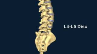 Herniated Disc [upl. by Scheer]