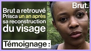 Reconstruction du visage  1 an après Prisca et sa prothèse dœil [upl. by Gloriana]