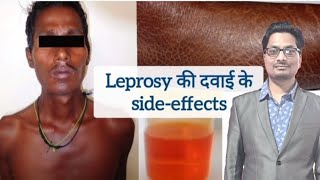 Leprosy की दवाइयों के sideeffects  Dapsone  Clofazimine  Rifampicin  Hansens disease leprosy [upl. by Eiuqnimod]