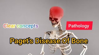 Pagets Disease Of Bone  Pathology  MAT Medicos [upl. by Wehhtam155]