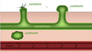 Ödemkomplikationen Manuelle Lymphdrainage [upl. by Gone768]