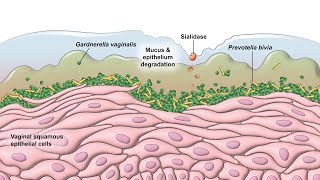 Bacterial Vaginosis  Pathogenesis [upl. by Micheil]