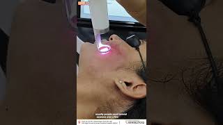 Get Rid of Acne Scars at Clear Skin Hair amp Laser Centre Kurnool Using Pico Laser Acne scar Treatment [upl. by Sam]