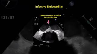 Infective Endocarditis [upl. by Cleopatre]