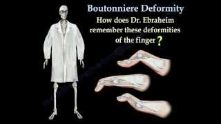 Boutonniere Deformity  Everything You Need To Know  Dr Nabil Ebraheim [upl. by Inalej4]