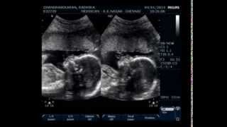 20 weeks 5 days Fetal Anomaly Scan Video  Part 2 [upl. by Nyrad312]