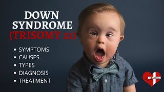 What is Down Syndrome Trisomy 21 Down syndrome Trisomy 21 Made Easy [upl. by Abas]