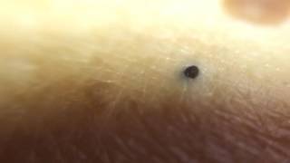 close up blackhead comedone extract 21 [upl. by Aldercy]