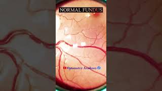 Normal fundus  Normal Retina  Smartphone Fundus Videography  Fundus Photography  Short Video 137 [upl. by Godliman]