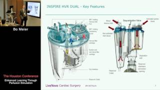 Unique Characteristics of the LivaNova Dual Reservoir Bo Meier [upl. by Edijabab163]