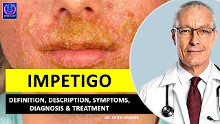 IMPETIGO Definition Description Causes and symptoms Diagnosis amp Treatment of Impetigo [upl. by Aehta477]